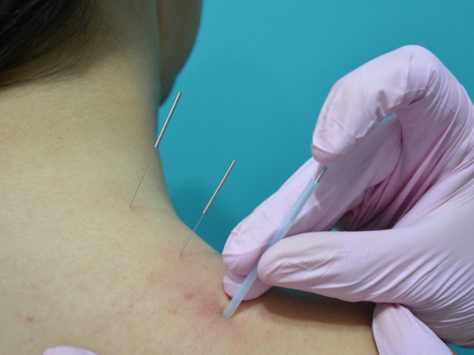 Dry needling