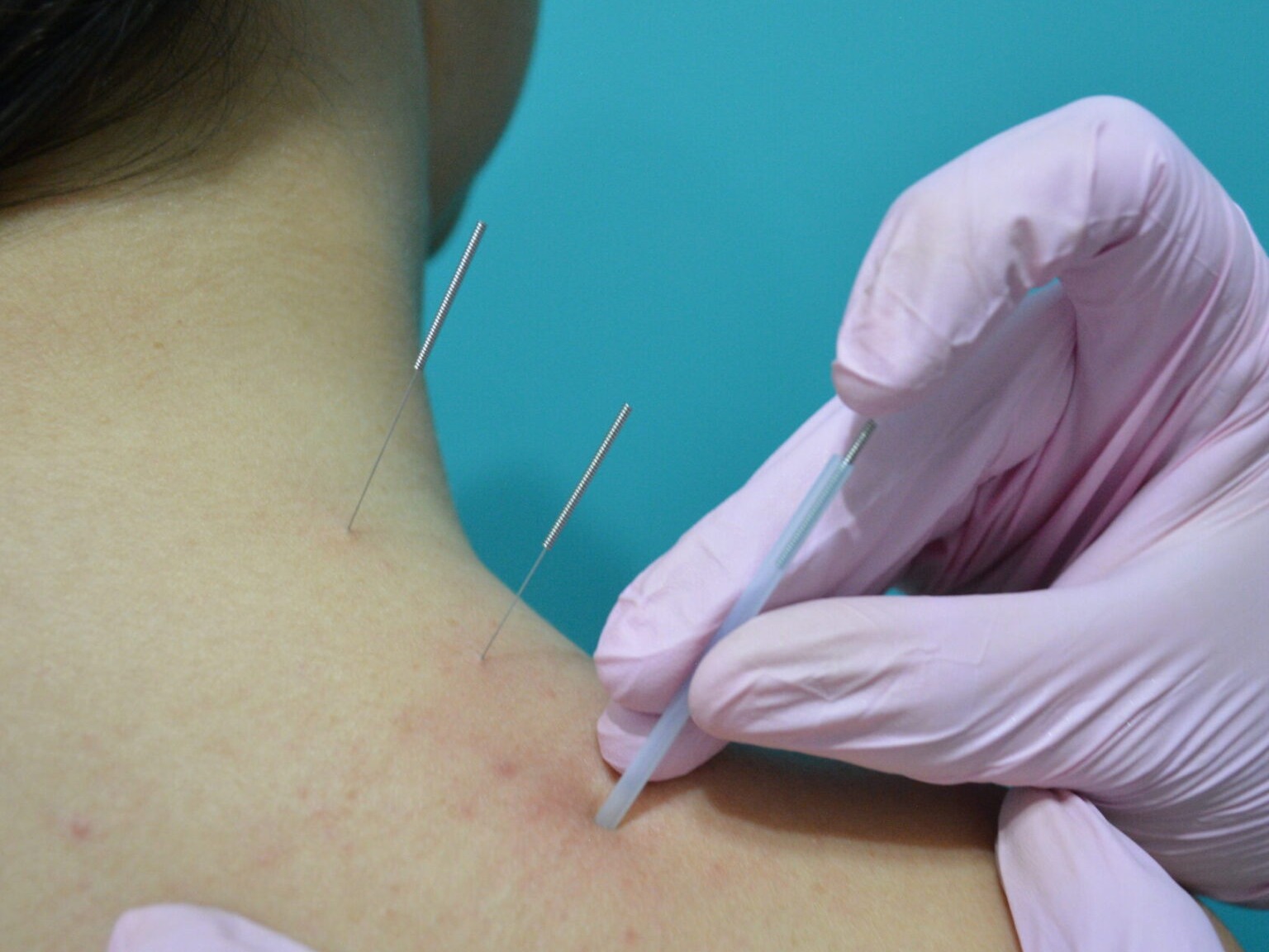 Dry needling