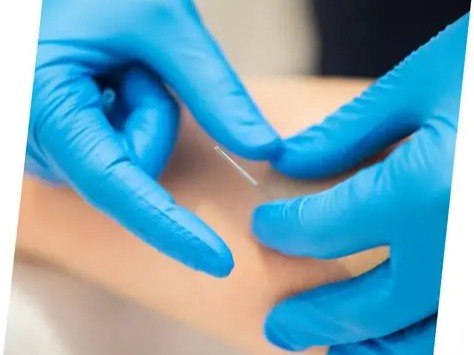 Dry Needling