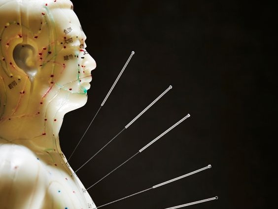 Acupuntura