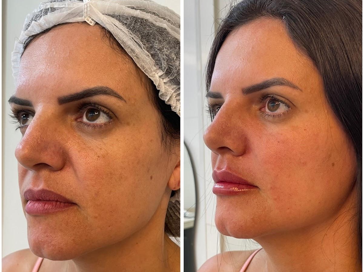 Estruturação Facial