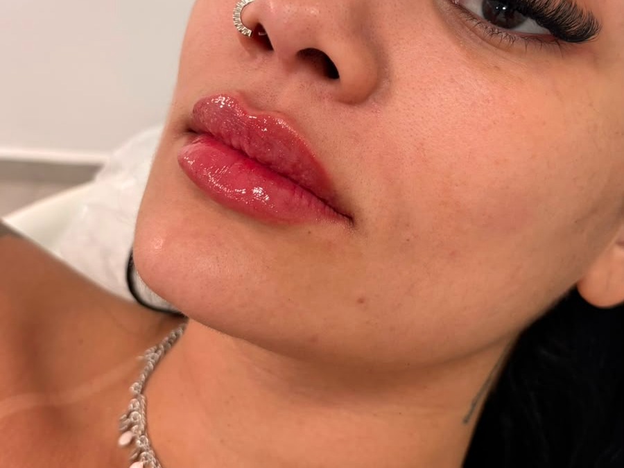 Preenchimento Labial