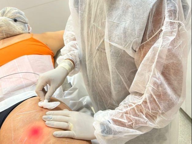 Laser para tratamento de Celulite e aderencias