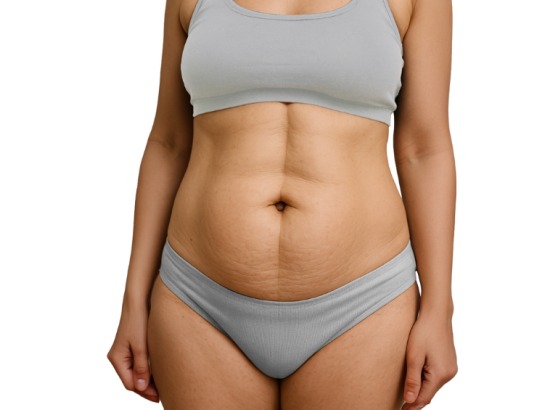 Diástase Abdominal