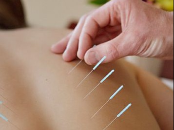 Acupuntura